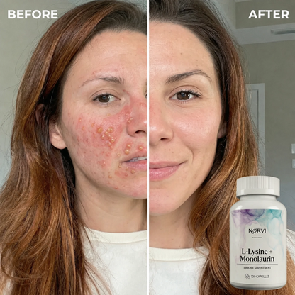 Lysine + Monolaurin Natural Herpes Support